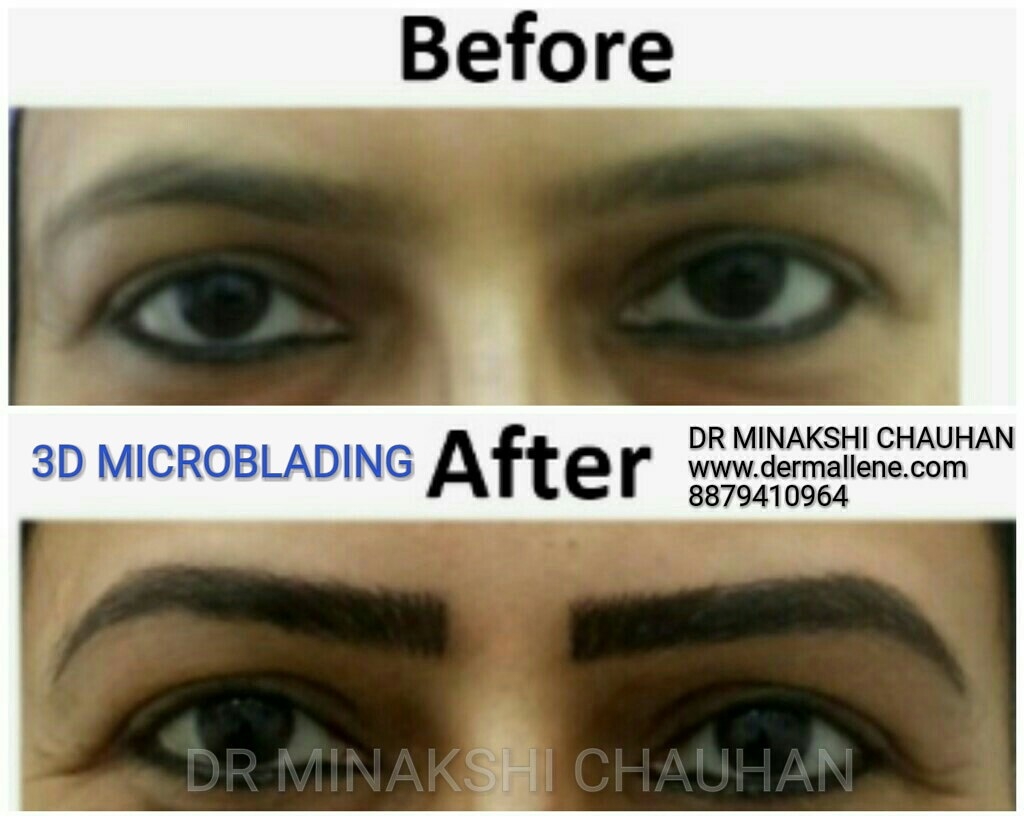 Microblading